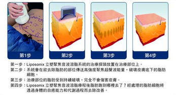 廠家直銷迪姿熱立塑聚焦超聲刀超聲波爆脂減肥機(jī)美體塑身儀器熱立塑減肥儀器